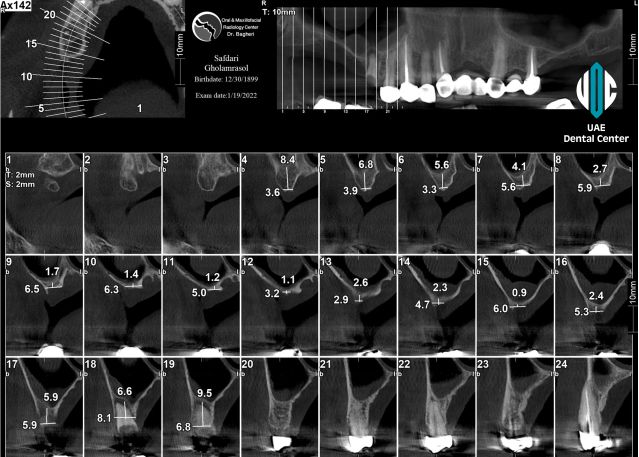 Bone Grafting Surgery in UAE (the United Arab Emirates in the Middle East)