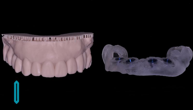 Digital Same-day Immediate Implant in UAE (the United Arab Emirates in the Middle East - DUBAI )