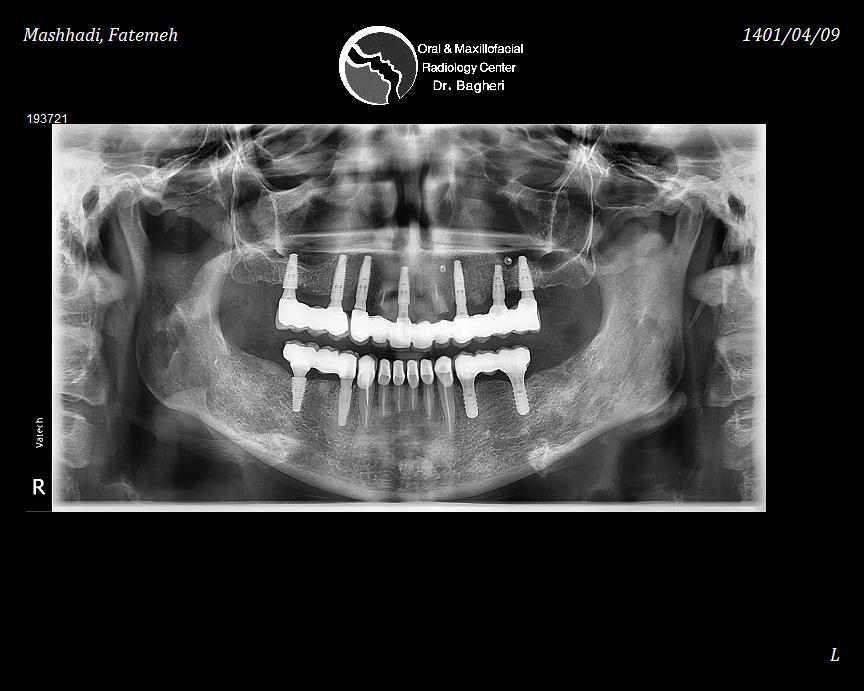 Full Mouth Rehabilitation in UAE ( United Arab Emirates- DUBAI )