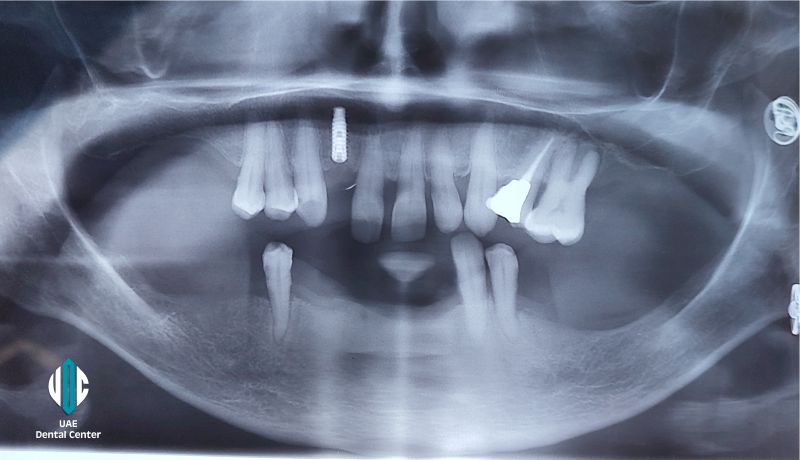 Same Day All on 6 Implants in UAE ( United Arab Emirates)