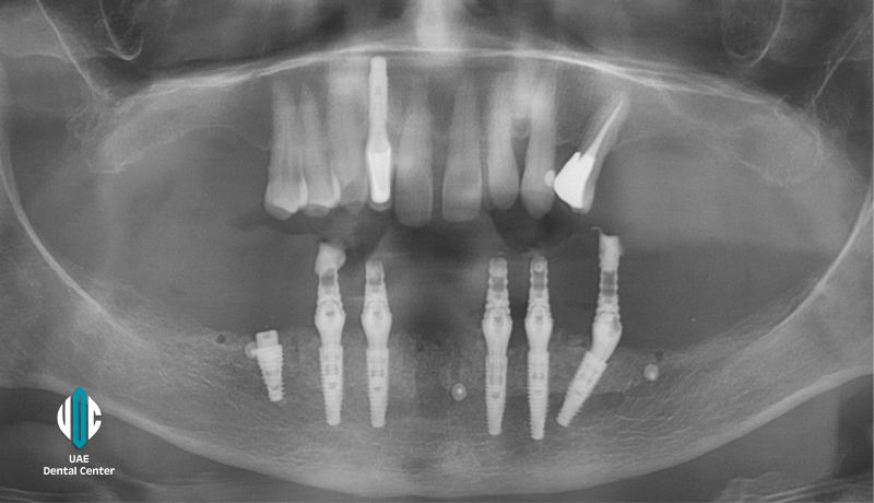 Same Day All on 6 Implants in UAE ( United Arab Emirates)