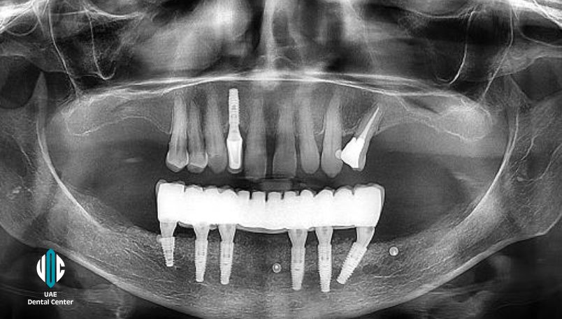 Same Day All on 6 Implants in UAE ( United Arab Emirates)